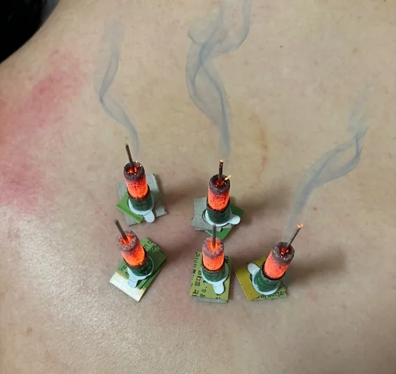 Moxibustion warming therapy